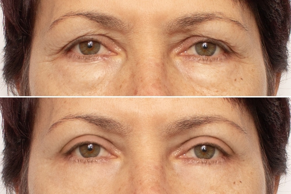 1747414246 oculoplastics