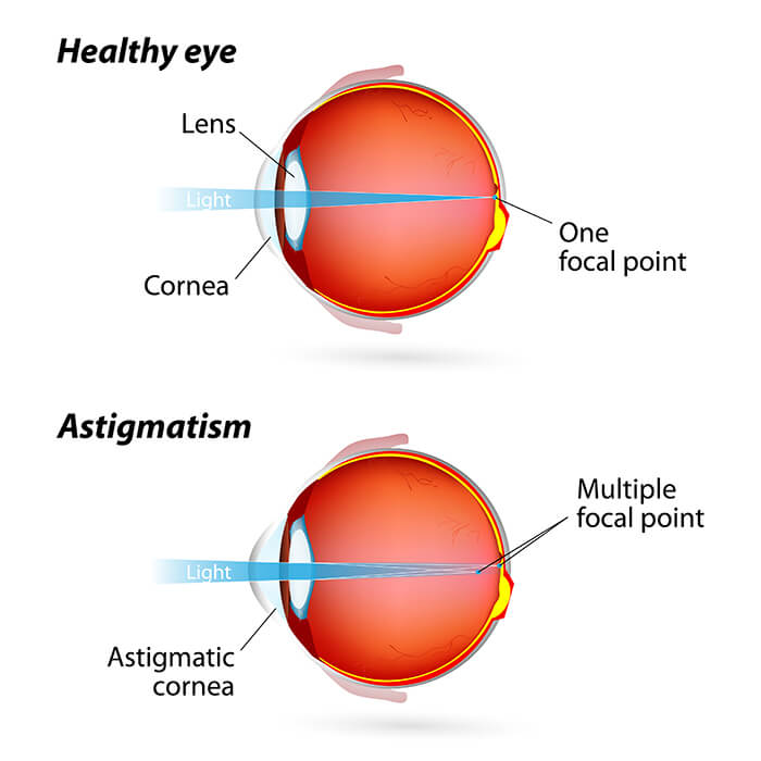 Chart showing a healthy eye compared to one with astigmatism