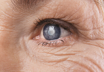 Cataract in the Eye