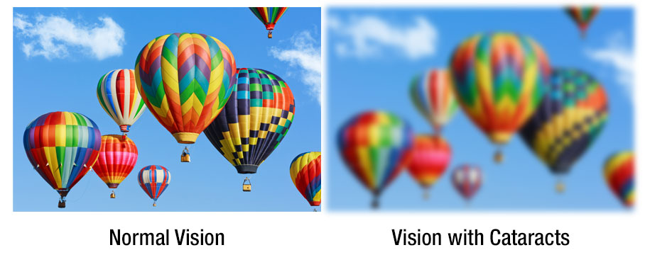 A graphic showing normal vision versus vision with cataracts