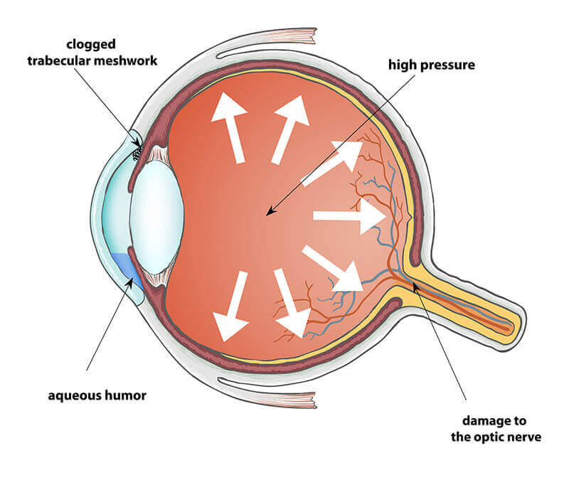 Chart Showing How Glaucoma Can Affect the Eye
