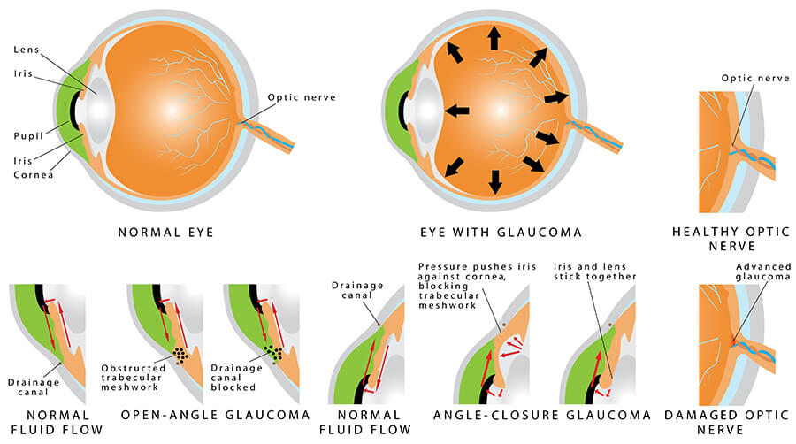 Chart Showing the Different Types of Glaucoma