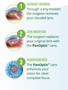 stages of PanOptix 